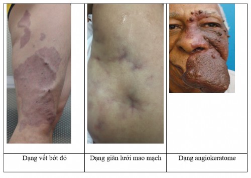 Dị dạng mao mạch