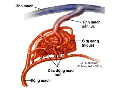 Dị dạng thông động tĩnh mạch