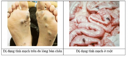 Dị dạng tĩnh mạch dạng phức tạp